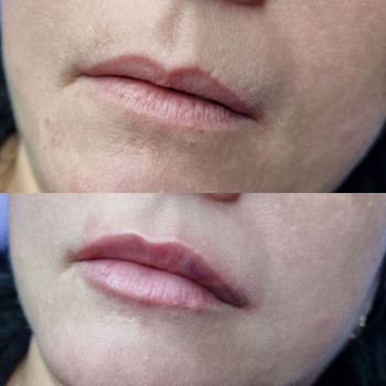 Відновлення втраченого з роками об'єму губ .