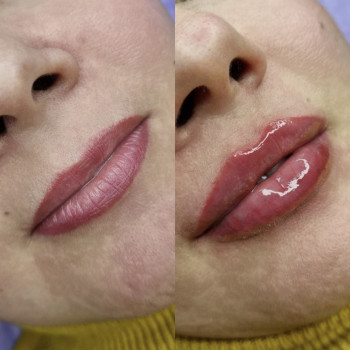 Відновлення втраченого об'єму губ .