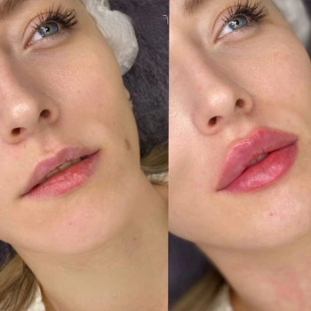 Збільшення губ філером гиалуронової кислоти.