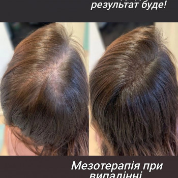 Мезотерапія випадіння волосся.