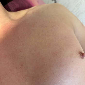 Груди чоловічі Після