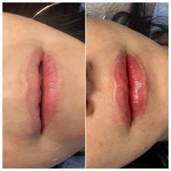 Аугментація губ
    