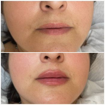 Аугментація губ
    