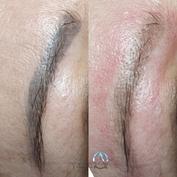 Видалення татуажу
                    Косметолог-эстетист Ольга Киев