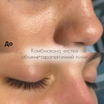 Комбінована чистка обличчя
    #