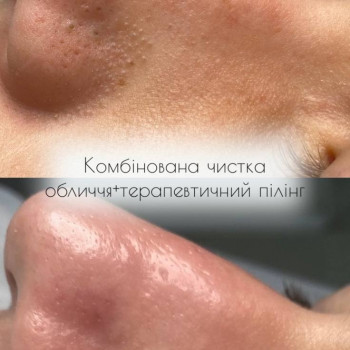 Комбінована чистка обличчя
    #