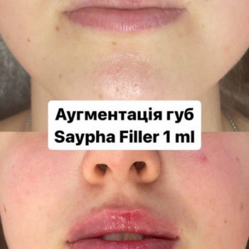 Аугментація губ
    