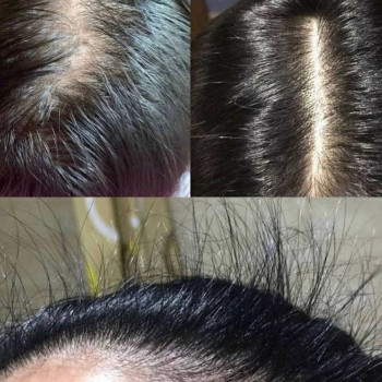 Лікування випадіння волосся.