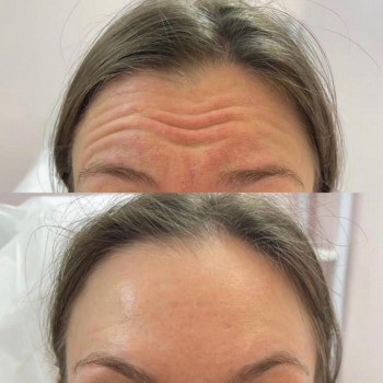 Ботулінотерапія