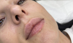 Контурна пластика губ – Croma Saypha (Австрія) 1 ml Салон краси  Одеса