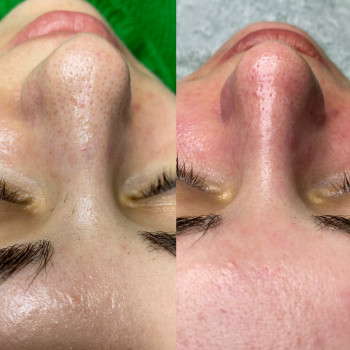 Чистка + пілінг по проблемі
                    Косметолог Людмила Киев