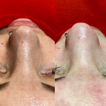 Чистка + пілінг по проблемі
                    Косметолог Людмила Киев