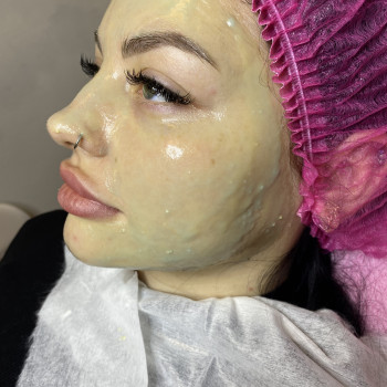 Ферментотерапія
                    Косметолог Людмила Київ