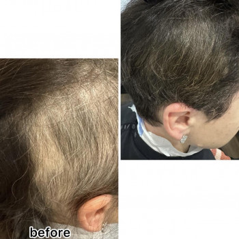 Безінєкційна мезотерапія волосся
                    Салон красоты Центр Красоты и Здоровья Волос Киев