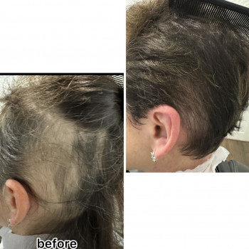 безінєкційна мезотерапія