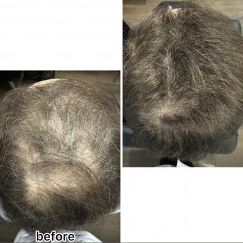 Безінєкційна мезотерапія волосся
                    Салон красоты Центр Красоты и Здоровья Волос Киев