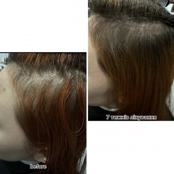 Безінєкційна мезотерапія волосся
                    Салон красоты Центр Красоты и Здоровья Волос Киев