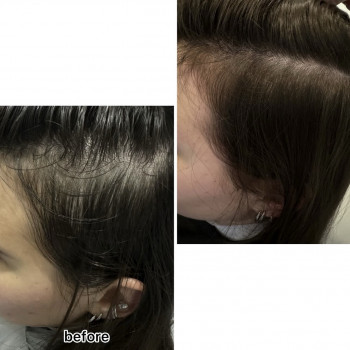 Безінєкційна мезотерапія волосся
                    Салон красоты Центр Красоты и Здоровья Волос Киев