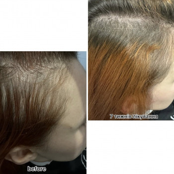 Безінєкційна мезотерапія волосся
                    Салон красоты Центр Красоты и Здоровья Волос Киев