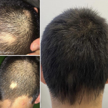 Кріотерапія з нанесенням лосьйону
                    Салон краси Центр Красоты и Здоровья Волос Київ