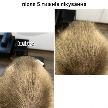 Кріотерапія з нанесенням лосьйону
                    Салон краси Центр Красоты и Здоровья Волос Київ