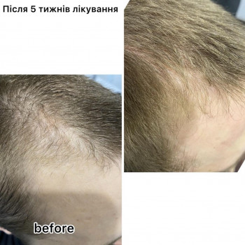 Кріотерапія з нанесенням лосьйону
                    Салон краси Центр Красоты и Здоровья Волос Київ