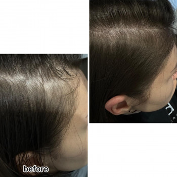 Кріотерапія з нанесенням лосьйону
                    Салон краси Центр Красоты и Здоровья Волос Київ