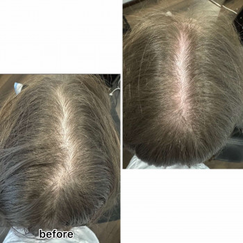 Кріотерапія з нанесенням лосьйону
                    Салон краси Центр Красоты и Здоровья Волос Київ