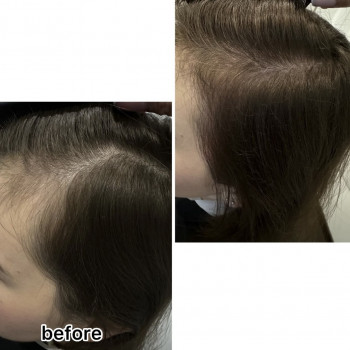 Лазерне лікування шкіри голови
                    Салон красоты Центр Красоты и Здоровья Волос Киев