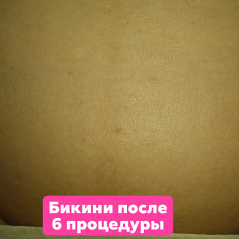 лазерная эпиляция бикини