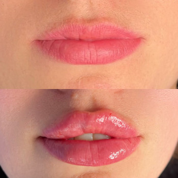 Збільшення губ
                    Мастер перманентного макияжа Екатерина Кременчуг