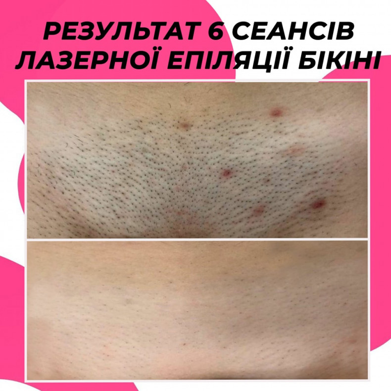 Лазерна епіляція зони глибокого бікіні  #лазернаепіляція, фото -  