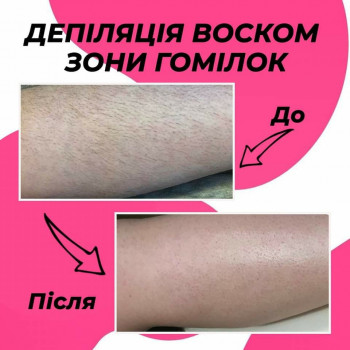 Лазерна епіляція гомілок
 