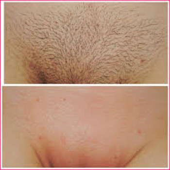 Бікіні. До та після