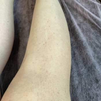 Ніжки. Після. Результат.