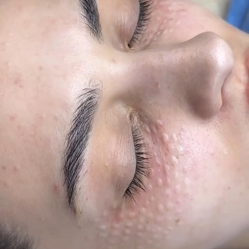  #мезотрапия #биоревитализация #мезотерапиявокругглаз #биоревитализациязоныглаз #биорепарация