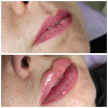 Збільшення губ
                    Косметолог Ольга Київ