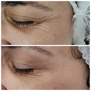 Ботокс очей