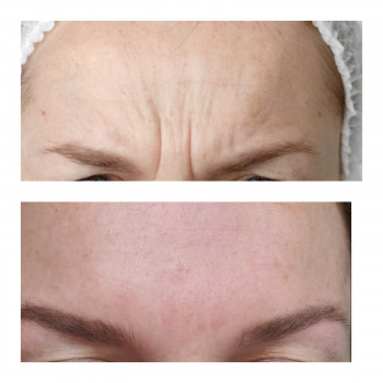 Ботокс міжбрів'я