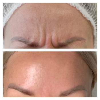 Ботокс міжбрів'я