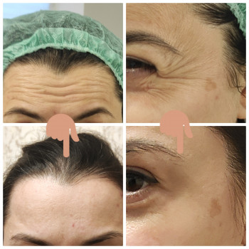 Міжбрів'я, лоб, очі