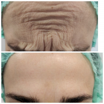 Ботокс міжбрів'я+лоб