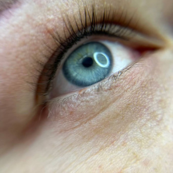 Межресничка