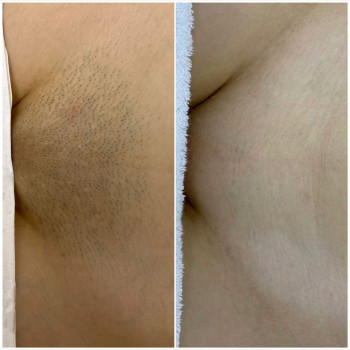 Profi Laser, Житомир Фото - 5