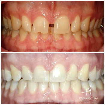 Фото з портфоліо фахівця Анастасія Рафальська (ортодонт, Черкаси)