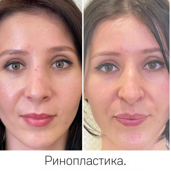 пластична операція обличчя