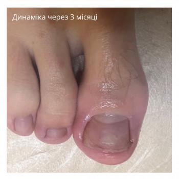вросший ноготь, лечение ногтей на ногах, лечение стопы