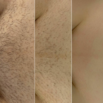 Прогрес під час курсу лазерної епіляції: різниця між 1, 3 та 8 сеансами.
 