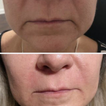 Контурна пластика. Збільшення вилиць. Усунення носогубної складки
                    Салон красоты  Киев