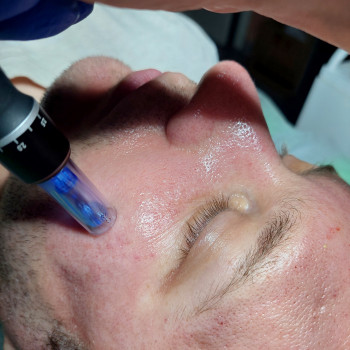 Фракционная микроигольчатая мезотерапия
                    Косметолог-эстетист Марина Одесса